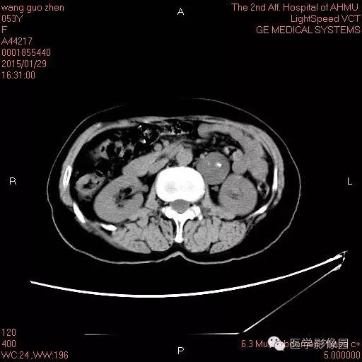 【病例】腹膜后神经鞘瘤1例CT影像表现与鉴别 【病例】腹膜后神经鞘瘤1例CT影像表现与鉴别