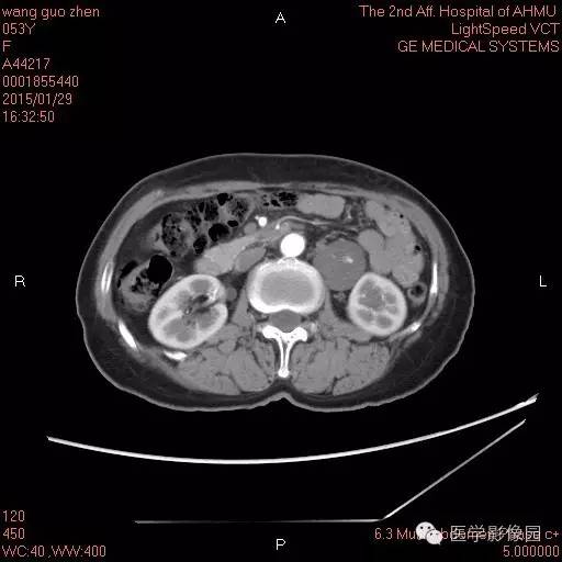 【病例】腹膜后神经鞘瘤1例CT影像表现与鉴别 【病例】腹膜后神经鞘瘤1例CT影像表现与鉴别