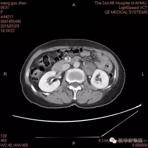 【病例】腹膜后神经鞘瘤1例CT影像表现与鉴别 【病例】腹膜后神经鞘瘤1例CT影像表现与鉴别