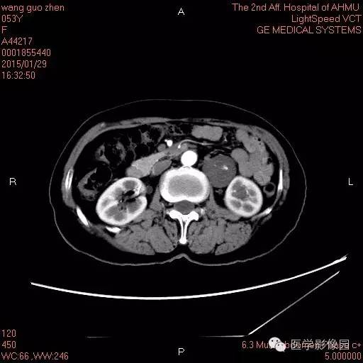 【病例】腹膜后神经鞘瘤1例CT影像表现与鉴别 【病例】腹膜后神经鞘瘤1例CT影像表现与鉴别