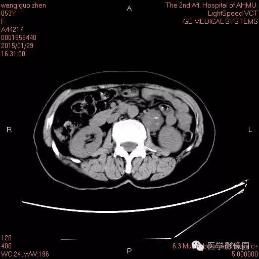 【病例】腹膜后神经鞘瘤1例CT影像表现与鉴别 【病例】腹膜后神经鞘瘤1例CT影像表现与鉴别