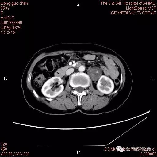 【病例】腹膜后神经鞘瘤1例CT影像表现与鉴别 【病例】腹膜后神经鞘瘤1例CT影像表现与鉴别