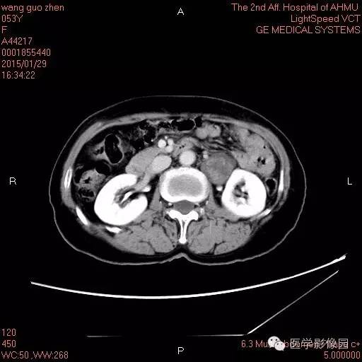【病例】腹膜后神经鞘瘤1例CT影像表现与鉴别 【病例】腹膜后神经鞘瘤1例CT影像表现与鉴别