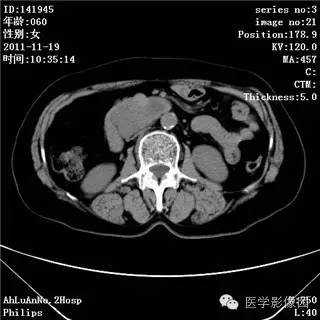 【病例】腹膜后去分化脂肪肉瘤1例CT影像表现