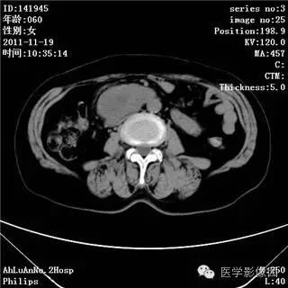 【病例】腹膜后去分化脂肪肉瘤1例CT影像表现 【病例】腹膜后去分化脂肪肉瘤1例CT影像表现