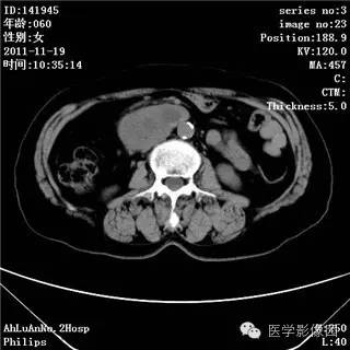 【病例】腹膜后去分化脂肪肉瘤1例CT影像表现 【病例】腹膜后去分化脂肪肉瘤1例CT影像表现