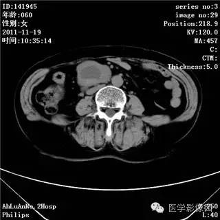 【病例】腹膜后去分化脂肪肉瘤1例CT影像表现 【病例】腹膜后去分化脂肪肉瘤1例CT影像表现