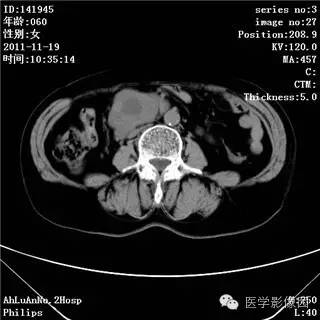 【病例】腹膜后去分化脂肪肉瘤1例CT影像表现 【病例】腹膜后去分化脂肪肉瘤1例CT影像表现
