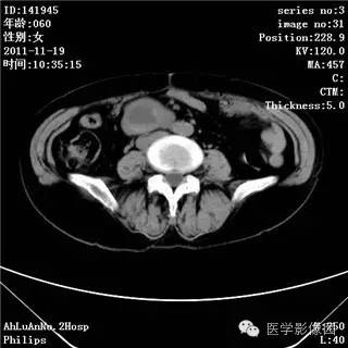 【病例】腹膜后去分化脂肪肉瘤1例CT影像表现 【病例】腹膜后去分化脂肪肉瘤1例CT影像表现