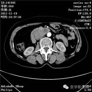 【病例】腹膜后去分化脂肪肉瘤1例CT影像表现 【病例】腹膜后去分化脂肪肉瘤1例CT影像表现