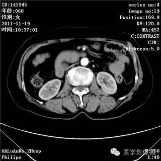 【病例】腹膜后去分化脂肪肉瘤1例CT影像表现 【病例】腹膜后去分化脂肪肉瘤1例CT影像表现