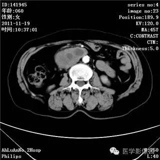 【病例】腹膜后去分化脂肪肉瘤1例CT影像表现 【病例】腹膜后去分化脂肪肉瘤1例CT影像表现