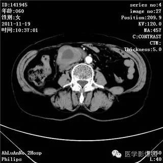 【病例】腹膜后去分化脂肪肉瘤1例CT影像表现 【病例】腹膜后去分化脂肪肉瘤1例CT影像表现