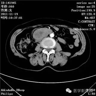 【病例】腹膜后去分化脂肪肉瘤1例CT影像表现 【病例】腹膜后去分化脂肪肉瘤1例CT影像表现