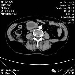 【病例】腹膜后去分化脂肪肉瘤1例CT影像表现 【病例】腹膜后去分化脂肪肉瘤1例CT影像表现