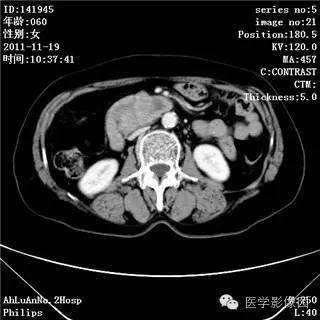【病例】腹膜后去分化脂肪肉瘤1例CT影像表现 【病例】腹膜后去分化脂肪肉瘤1例CT影像表现