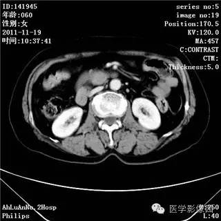 【病例】腹膜后去分化脂肪肉瘤1例CT影像表现 【病例】腹膜后去分化脂肪肉瘤1例CT影像表现