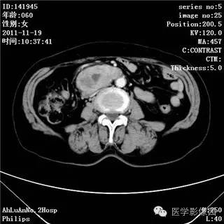 【病例】腹膜后去分化脂肪肉瘤1例CT影像表现 【病例】腹膜后去分化脂肪肉瘤1例CT影像表现