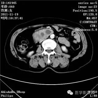 【病例】腹膜后去分化脂肪肉瘤1例CT影像表现 【病例】腹膜后去分化脂肪肉瘤1例CT影像表现