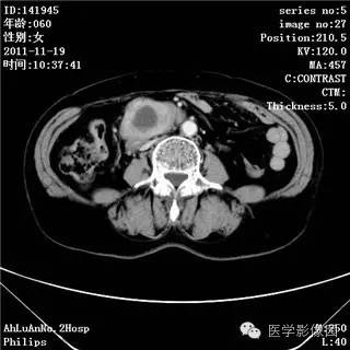 【病例】腹膜后去分化脂肪肉瘤1例CT影像表现 【病例】腹膜后去分化脂肪肉瘤1例CT影像表现