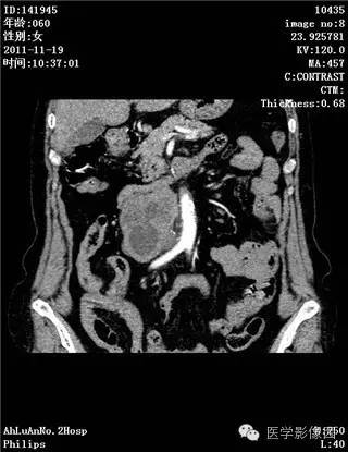 【病例】腹膜后去分化脂肪肉瘤1例CT影像表现 【病例】腹膜后去分化脂肪肉瘤1例CT影像表现
