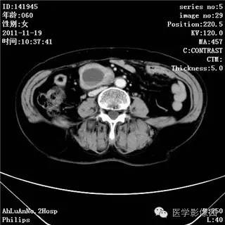 【病例】腹膜后去分化脂肪肉瘤1例CT影像表现 【病例】腹膜后去分化脂肪肉瘤1例CT影像表现
