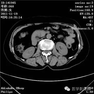 【病例】腹膜后去分化脂肪肉瘤1例CT影像表现 【病例】腹膜后去分化脂肪肉瘤1例CT影像表现