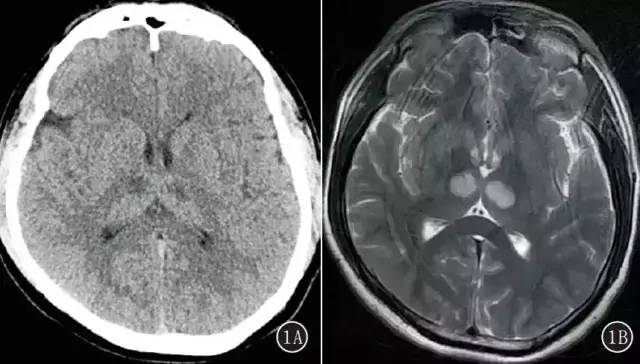 CT、MRI 诊断Percheron 动脉综合征