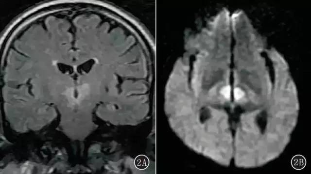 CT、MRI 诊断Percheron 动脉综合征