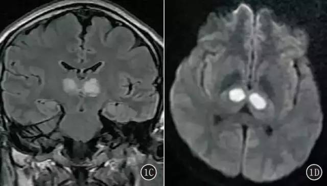 CT、MRI 诊断Percheron 动脉综合征