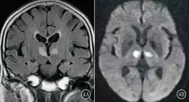 CT、MRI 诊断Percheron 动脉综合征