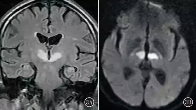 CT、MRI 诊断Percheron 动脉综合征