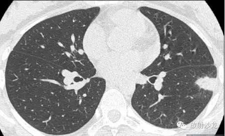 【病例】肺梗死一例CT影像表现