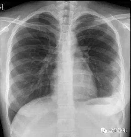 【病例】肺梗死一例CT影像表现