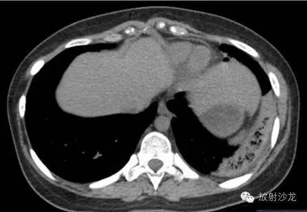 【病例】肺梗死一例CT影像表现