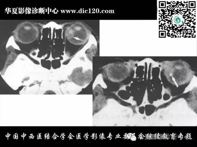 【PPT】眼及眼眶常见病变的影像诊断