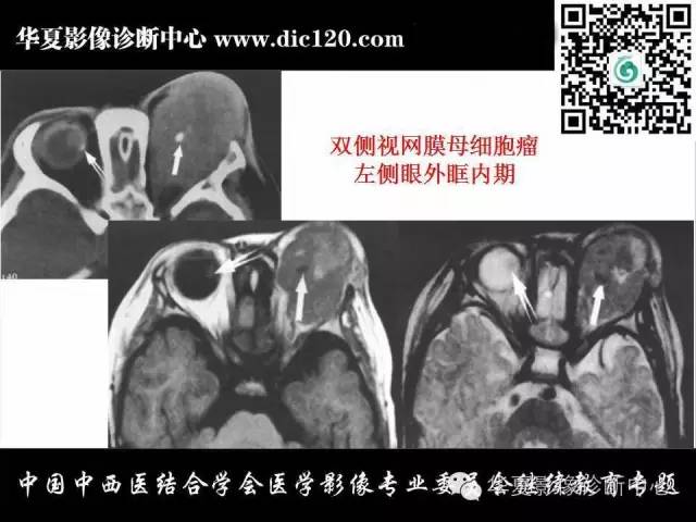 【PPT】眼及眼眶常见病变的影像诊断
