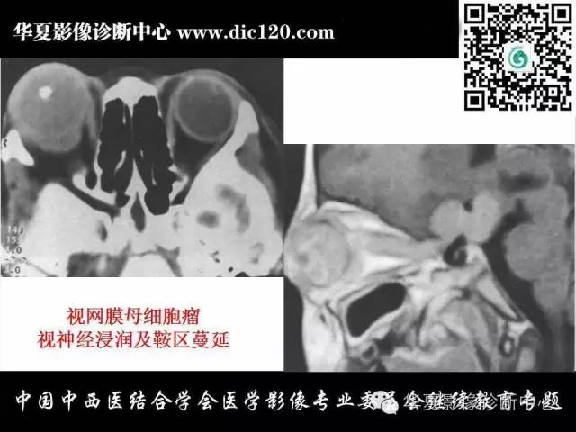 【PPT】眼及眼眶常见病变的影像诊断