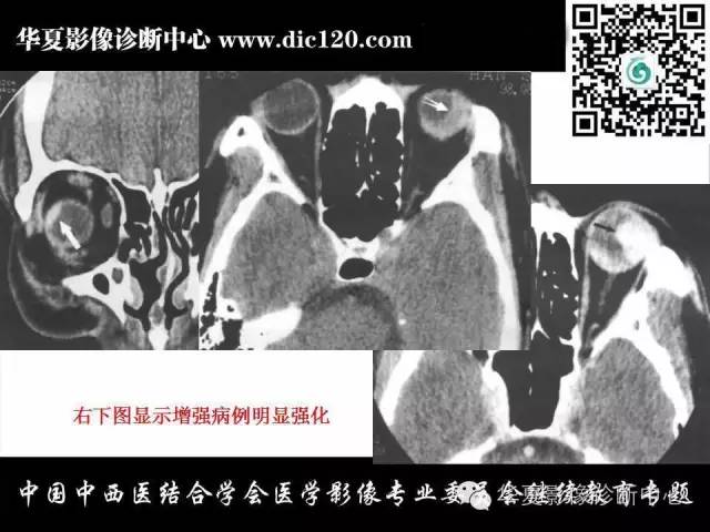 【PPT】眼及眼眶常见病变的影像诊断