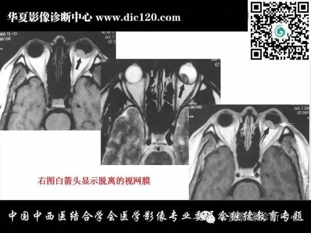 【PPT】眼及眼眶常见病变的影像诊断