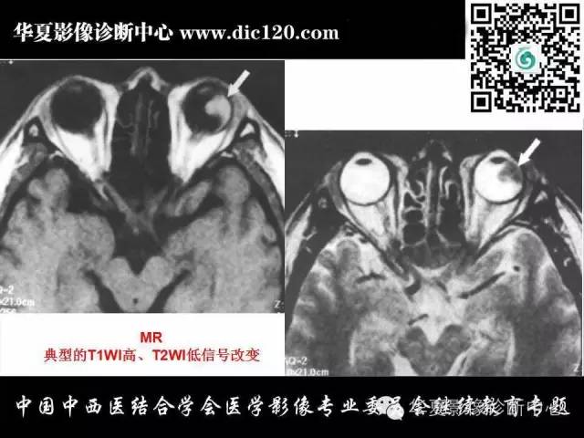 【PPT】眼及眼眶常见病变的影像诊断