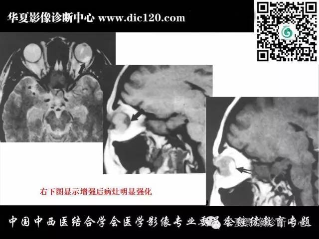 【PPT】眼及眼眶常见病变的影像诊断