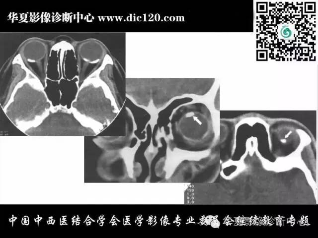 【PPT】眼及眼眶常见病变的影像诊断