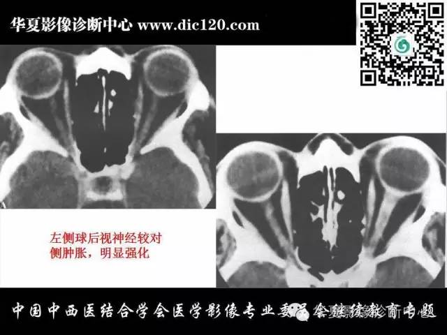 【PPT】眼及眼眶常见病变的影像诊断