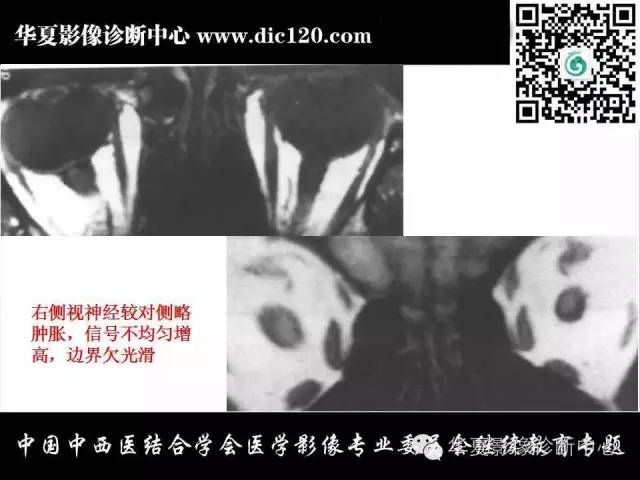 【PPT】眼及眼眶常见病变的影像诊断