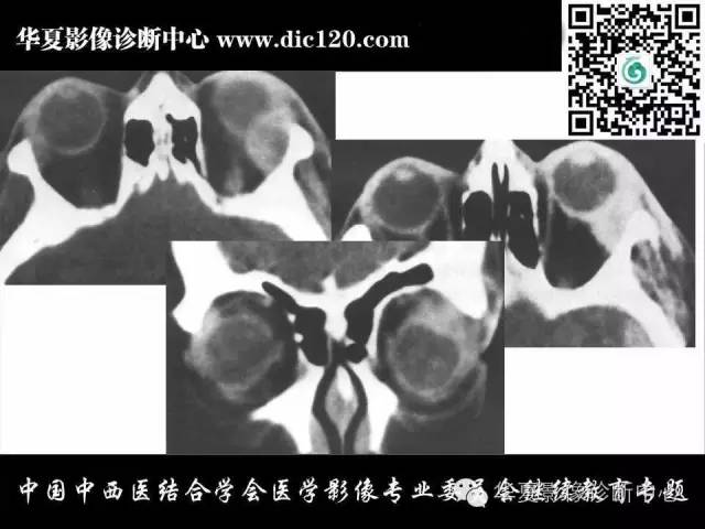 【PPT】眼及眼眶常见病变的影像诊断