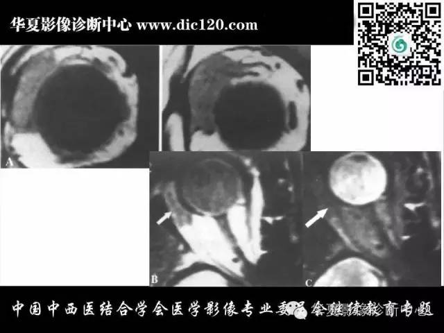 【PPT】眼及眼眶常见病变的影像诊断