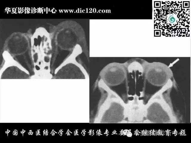 【PPT】眼及眼眶常见病变的影像诊断