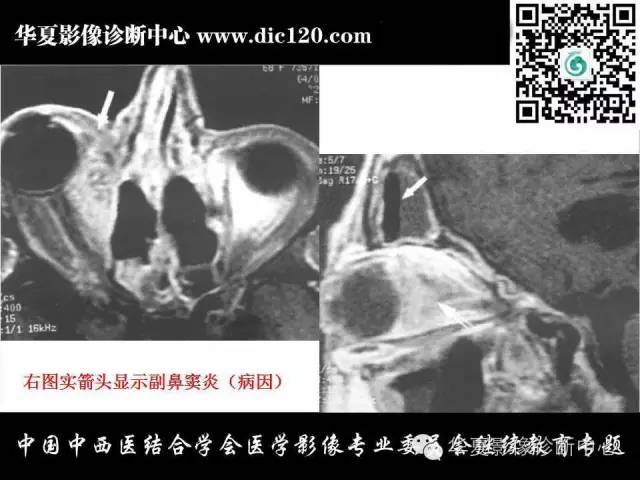 【PPT】眼及眼眶常见病变的影像诊断