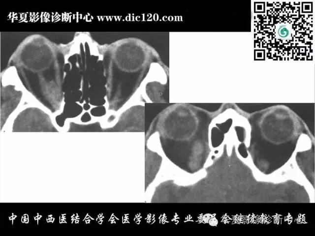 【PPT】眼及眼眶常见病变的影像诊断